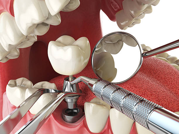 Best Emergency Treatment for Toothache in Attica, MI